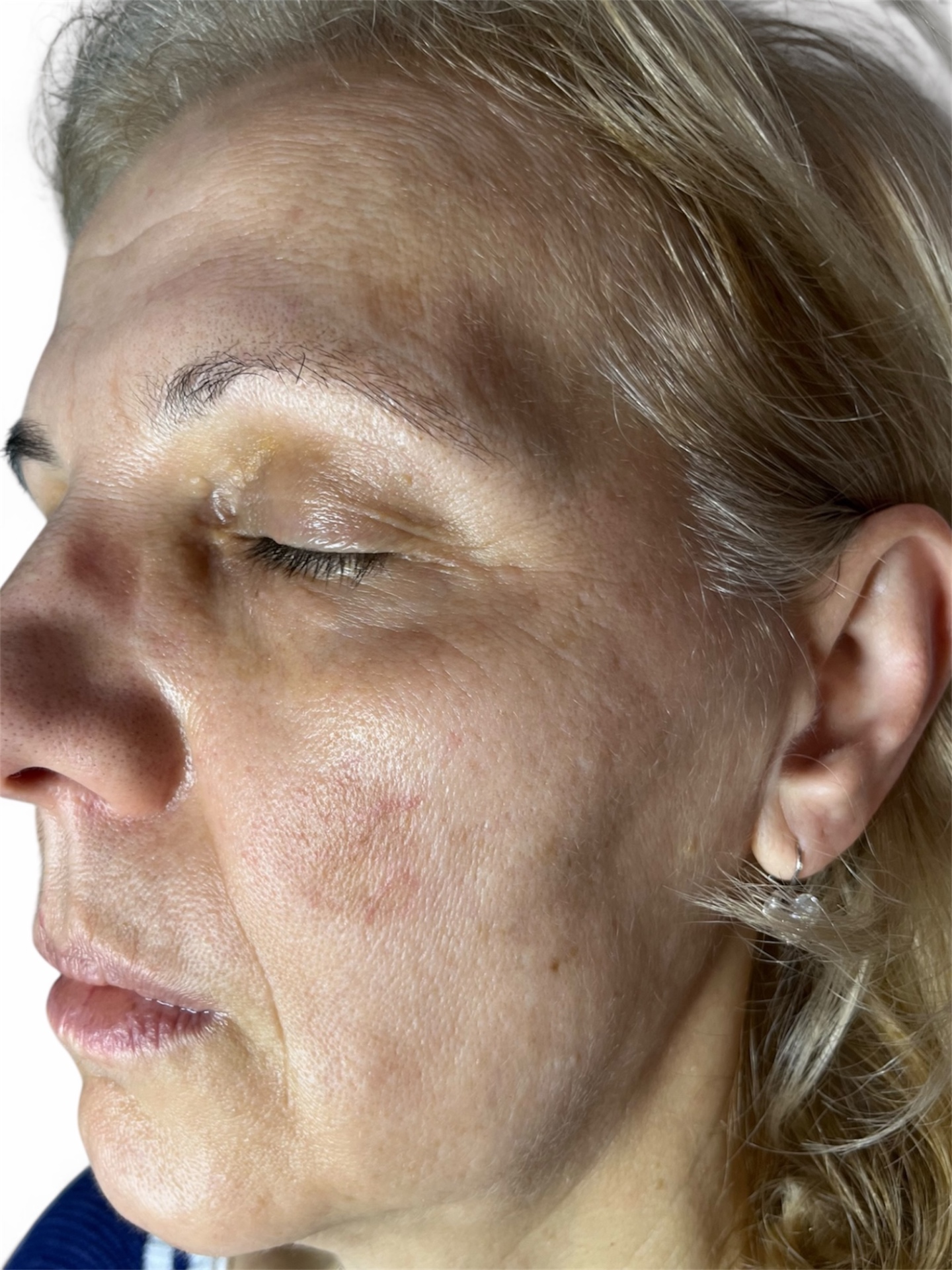 Post-Plasma Pen Pigmentation — Day 7 (After)