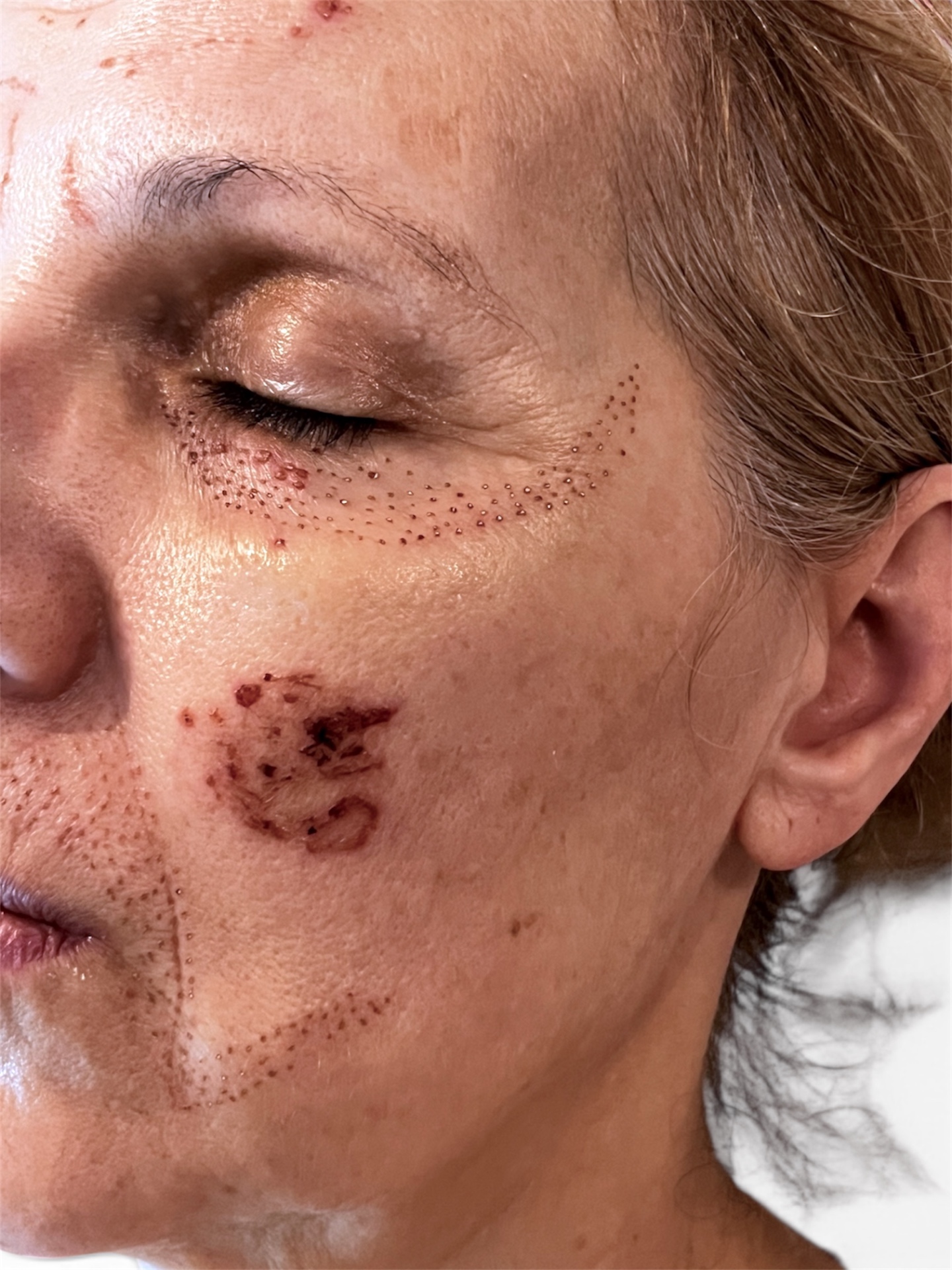 Post-Plasma Pen Pigmentation — Day 0 (Before)