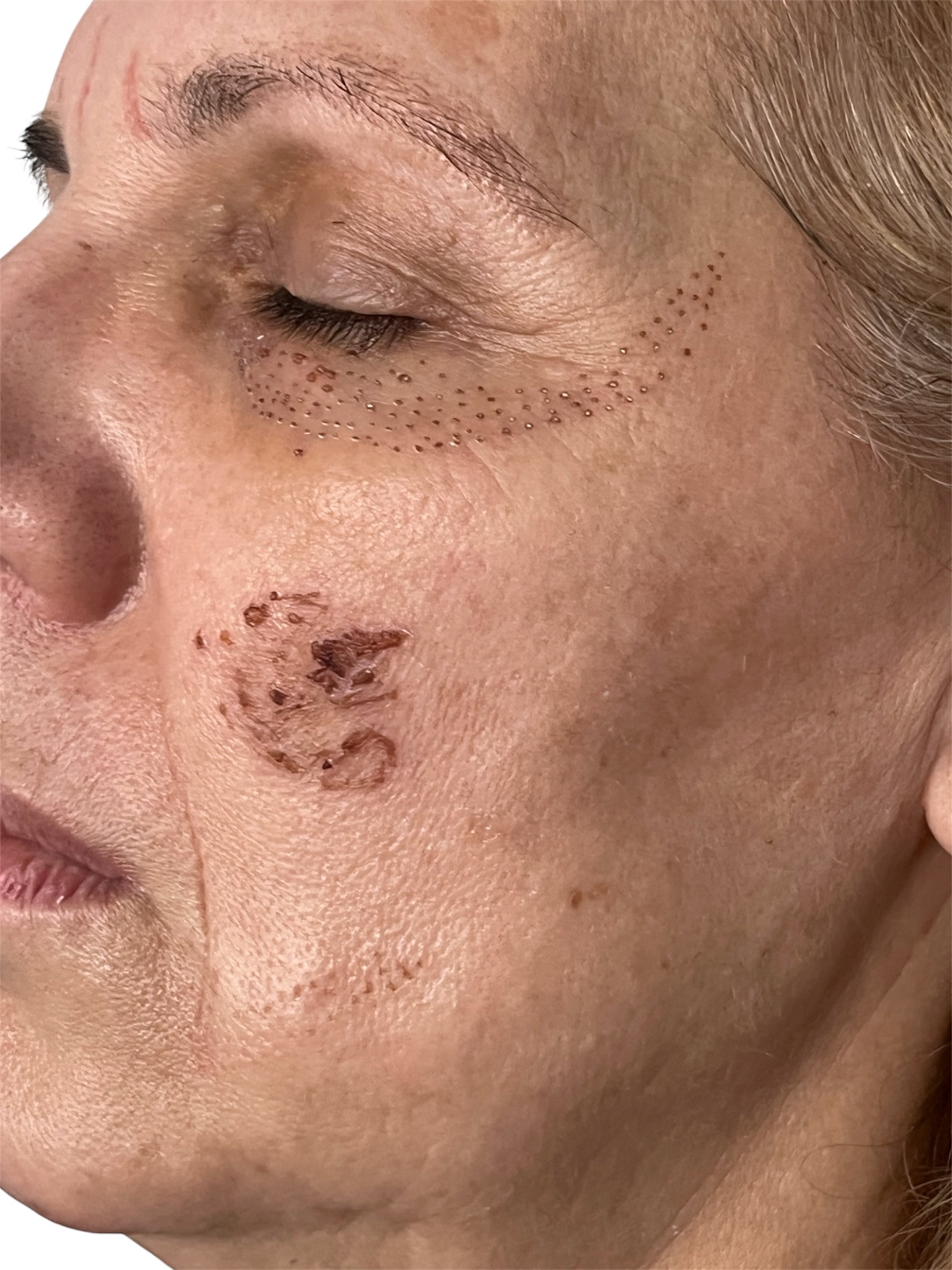 Post-Plasma Pen Pigmentation — Day 3 (Progress)